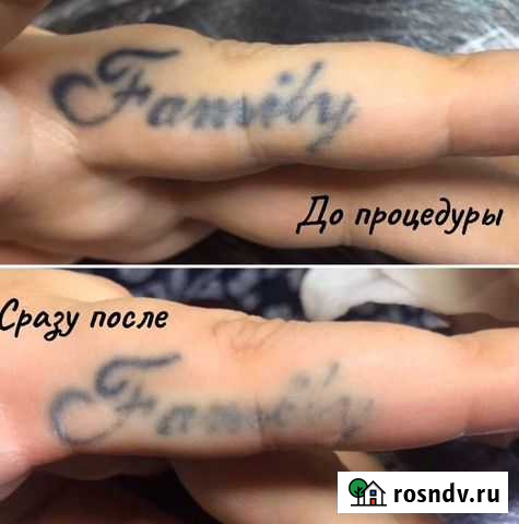 Удаление тату, татуажа, карбоновый пилинг Петропавловск-Камчатский - изображение 1
