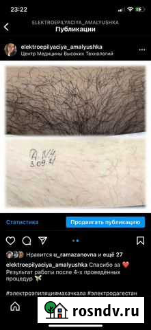 Электроэпиляция Махачкала - изображение 1