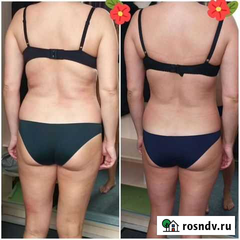 Вакумный массаж. Коррекция фигуры Курск - изображение 1