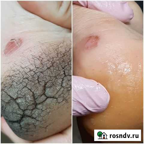 Педикюр/подолог/маникюр со сложностями и проблемам Новосибирск - изображение 1