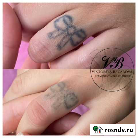 Удаление тату и татуажа Старый Оскол - изображение 1