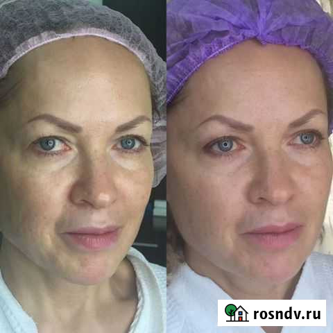 Пилинг биоревитализирующий Новосибирск - изображение 1