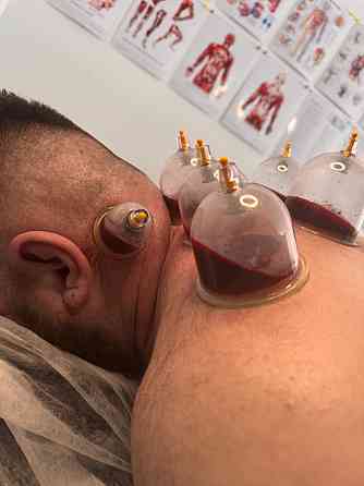 Хиджама оздоровительная Таганрог