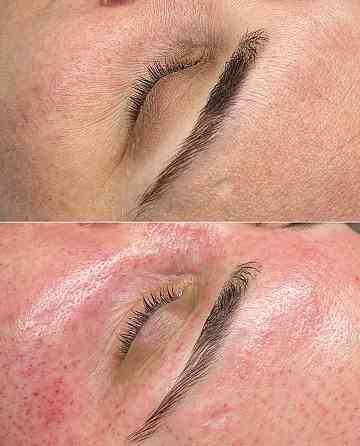 Лифтинг Хиджама лица Таганрог