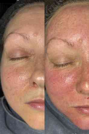 Лифтинг Хиджама лица Таганрог