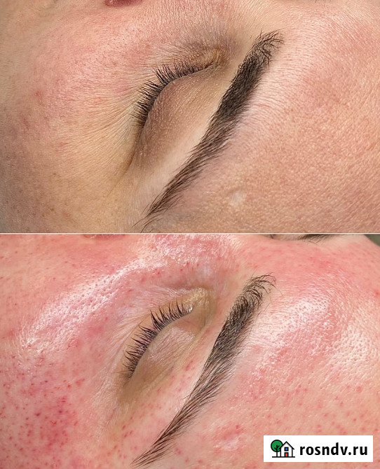 Лифтинг Хиджама лица Таганрог - изображение 2