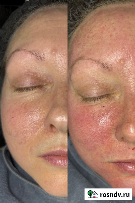 Лифтинг Хиджама лица Таганрог - изображение 1